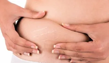6 remedios para atenuar las estrías en casa