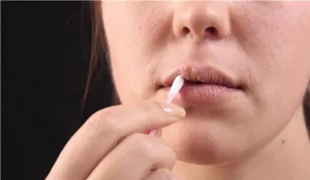 Herpes: la infección que sufren millones de personas (y capaz tú también)
