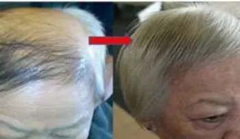 Ponte unas gotas de este jarabe en tu cuero cabelludo y tu pelo volverá a crecer...¡impresionante!