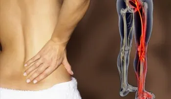 8 remedios naturales para tratar la ciática