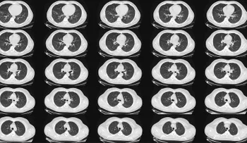 Publican nuevas pautas para la detección cáncer de pulmón