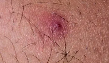 Cómo tratar la foliculitis
