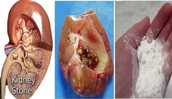 Cómo reparar los riñones de forma natural con bicarbonato de sodio