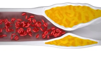 Tratamiento efectivo para la aterosclerosis