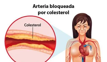 Una persona con colesterol no puedes cometer estos errores: 