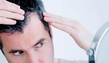 Alopecia androgenética, ¿igual en hombres que en mujeres?