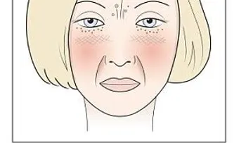 Leche, azúcar, gluten y alcohol pueden afectar la apariencia del rostro