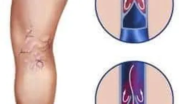 Tratamientos para las varices