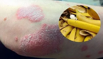 La cáscara de plátano es la solución para las arrugas, verrugas y psoriasis... ENTÉRATE!!