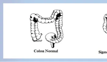 Limpieza del colon ayuda a bajar la barriga
