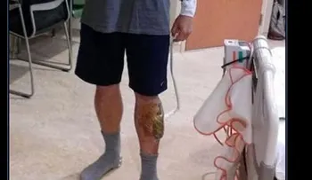 Un hombre mordido por una serpiente, atacado por un tiburón y dos monos, le cayó un rayo, y sobrevive