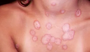 Bicarbonato con vinagre, agua tibia y jengibre para los hongos en la piel