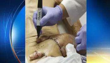 Un hombre salva mano quemada... dentro de su estómago