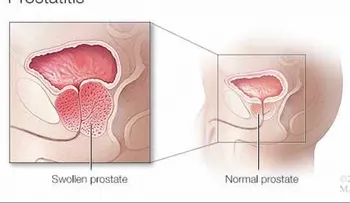 Algunos tipos de prostatitis pueden ser difíciles de tratar