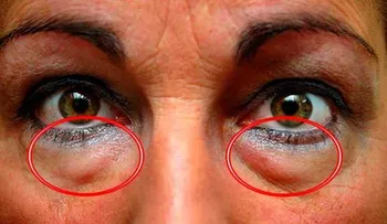 Con 5 minutos al día elimina las ojeras y bolsas debajo de los ojos: Solo presta atención y toma nota 
