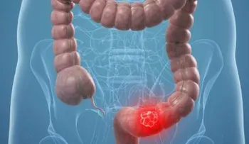 Descubren eficacia de árnica contra cáncer de colon