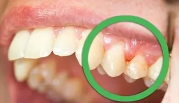 Remedios para la sensibilidad dental; recomendaciones (VIDEO)