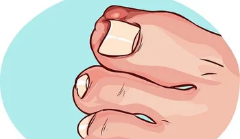 Remedios ancestrales para uñas enterradas o encarnadas