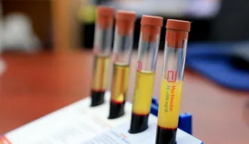 La sobrecarga de colesterol en el hígado causa tumores más agresivos, según estudio