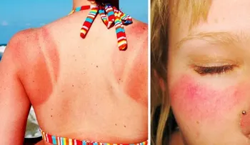 Remedios que no fallan para quemaduras solares y domésticas: agua fría, aloe vera, aceite herbal, manzanilla y tomillo
