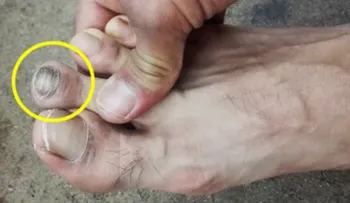 ¿Conoces a alguien que tenga este dedo más grande que los otros? ¡Mucho cuidado!