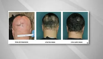 Medicamento revierte pérdida del cabello en un tipo de alopecia