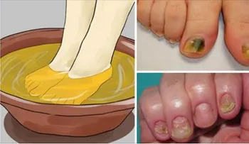 Remedio con 3 ingredientes para eliminar los hongos de las uñas, para toda la vida!!!â?¦ esto está buenísimo.