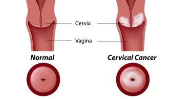 El virus del papiloma humano, causas y prevención