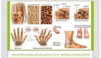 Las enfermedades del sistema esquelético