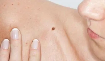 Diferencias entre lunares y verrugas