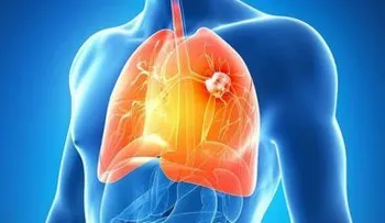 El 25 por ciento casos cáncer de pulmón desarrollan metástasis cerebral