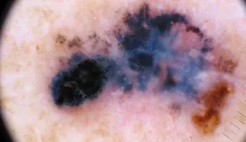 Merck y Moderna reportan avance en vacuna personalizada contra el melanoma, que podría allanar el camino a otras inmunizaciones oncológicas