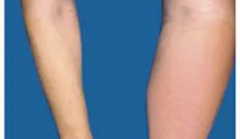 Acumulación de líquido o linfedema