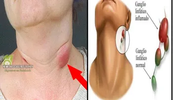 Desinflama los ganglios linfáticos en 5 minutos con este eficaz remedio 