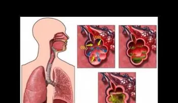 Bronquitis (VIDEO