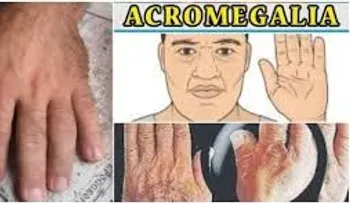 Acromegalia: enfermedad crónica que hace crecer manos, pies y rostro