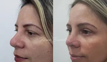  Procedimiento quirúrgico que logra rejuvenecer la piel casi se inmediato, la blefaroplastia