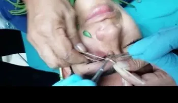 Extraen larva de mosca del ojo de un joven peruano (VIDEO)