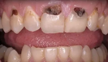 Las caries no serán nunca más un problema. ¡Tu dentista dirá cómo rayos lo hiciste!  (VIDEO)