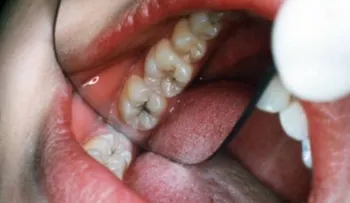 El aceite de coco tiene un poder increíble para eliminar las caries de forma natural