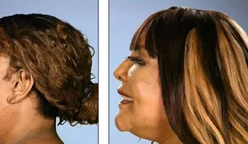 Una mujer se inyectó cemento en la cara; mira ahora su transformación 
