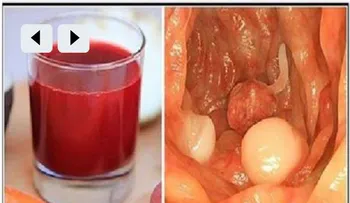 El cáncer muere dentro de las próximas 42 Horas â?¦ Este jugo a curado más de 50 mil personas!