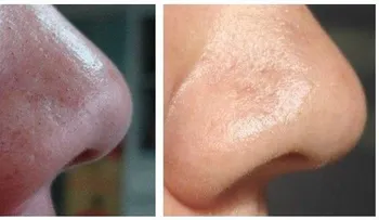 Bicarbonato de sodio para eliminar las espinillas