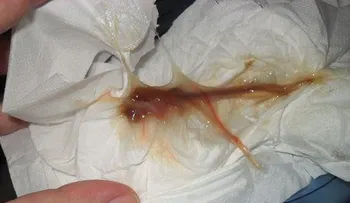 ¿Qué causa el moco cervical marrón ? ¿Debes preocuparte?