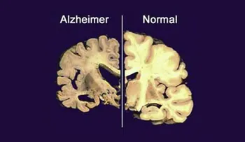 5 cosas que no sabías sobre el Alzheimer