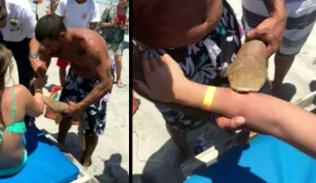 Mujer mordida por tiburón fue trasladada al hospital con el animal aún colgando de su brazo