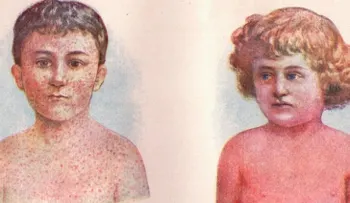 La fiebre escarlata enfermedad del siglo XIX regresa con una fuerte intensidad 