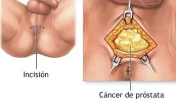 Cloruro de magnesio alarga la juventud, previene y cura la próstata