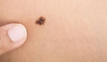 Las mujeres son más propensas a padecer melanoma