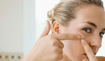 5 pasos para un rostro libre de acné